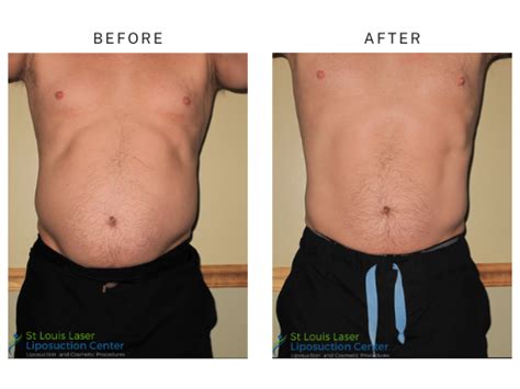 liposuction cost st louis|Top Liposuction Doctors in Saint Louis, MO